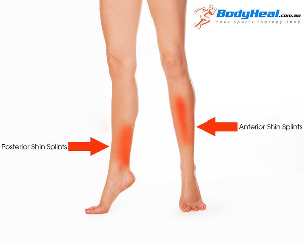 shin splints posterior anterior pain