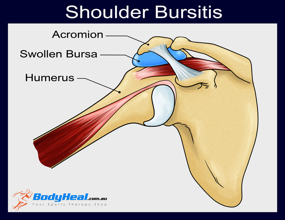 swollen shoulder bursa causing bursitis