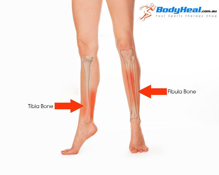 What Is Shin Splints Causes Symptoms And Treatment Options Bodyheal