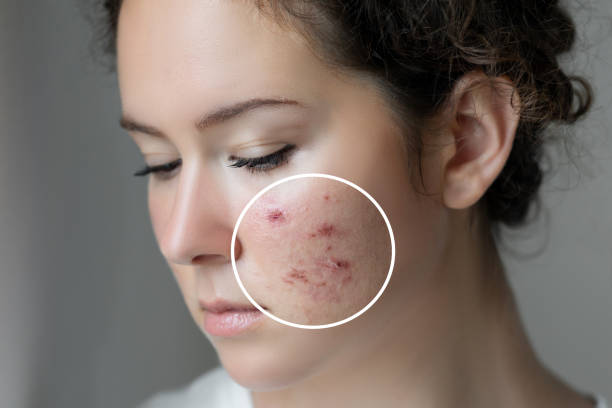 female face having acnes