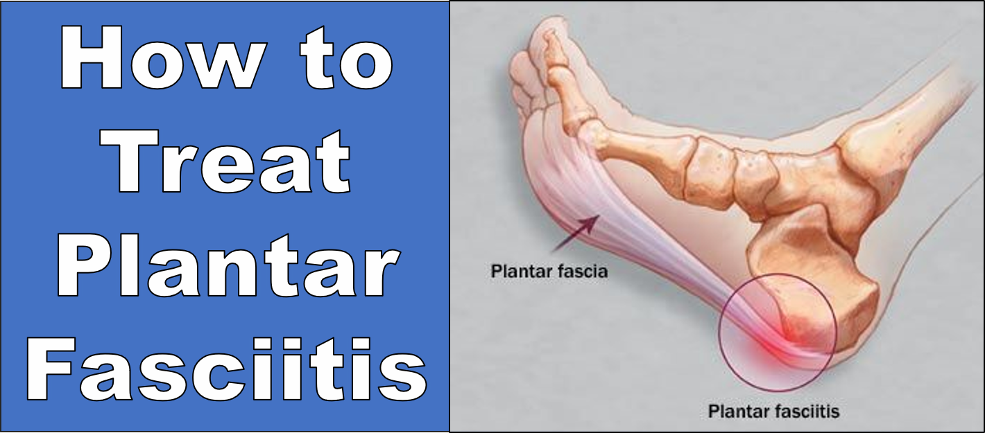 fascia plantitis treatment