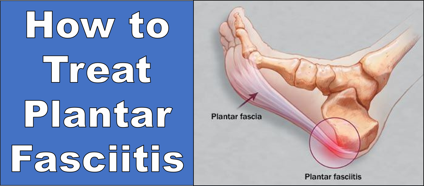 ways to cure plantar fasciitis