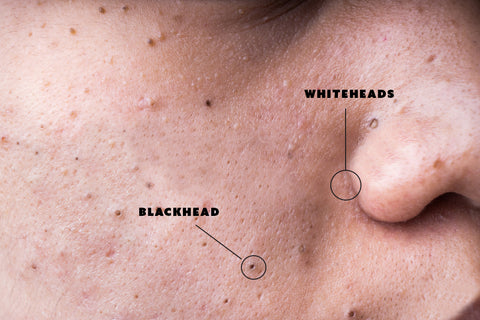Photograph of a person's face which shows the difference between a blackhead and a whitehead.