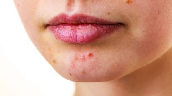 Acne on a person's chin.