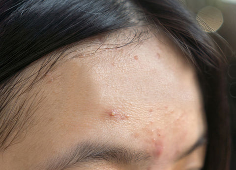 Photograph of a girls forehead with an acne breakout in progress.