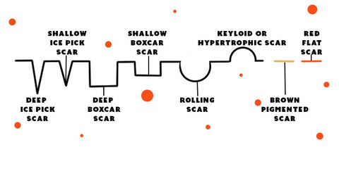 Illustration depicting the different types of acne scars. 