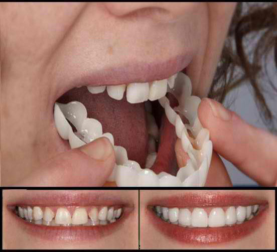 instant snap on veneers