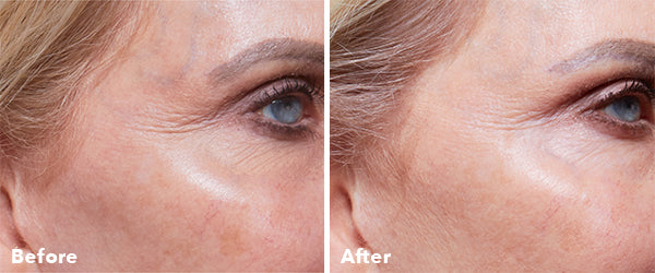 AnteAGE Home Microneedling Before & After