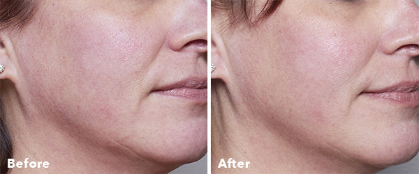 AnteAGE Home Microneedling Before & After