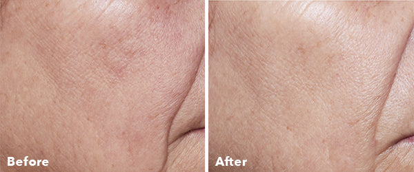 AnteAGE Home Microneedling Before & After