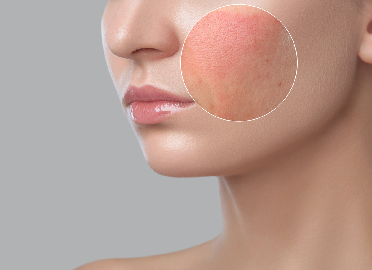 verschillende soorten huidtypes - gevoelige huid