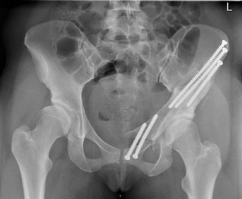 dog hip dysplasia 