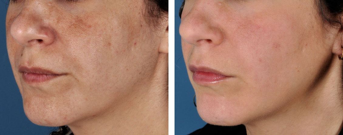 Before and After using ZO Non-Hydroquinone Hyperpigmentation System