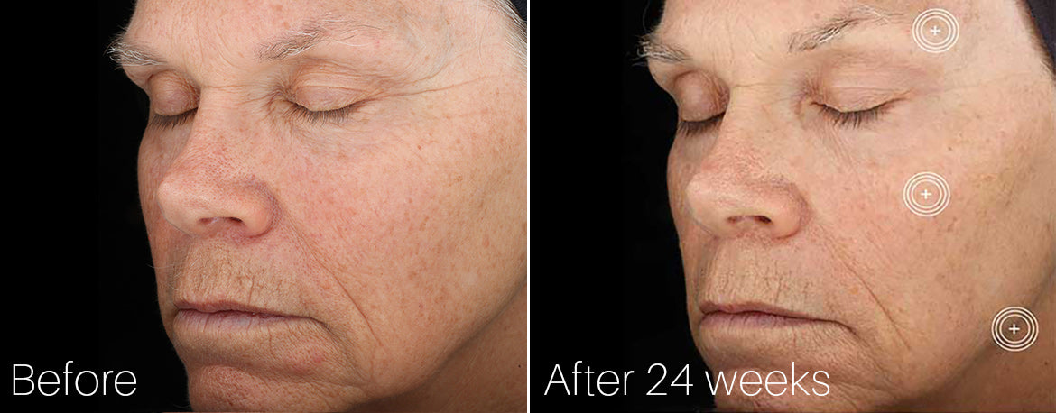 SkinMedica TNS Advanced Serum Before and After 24 Weeks