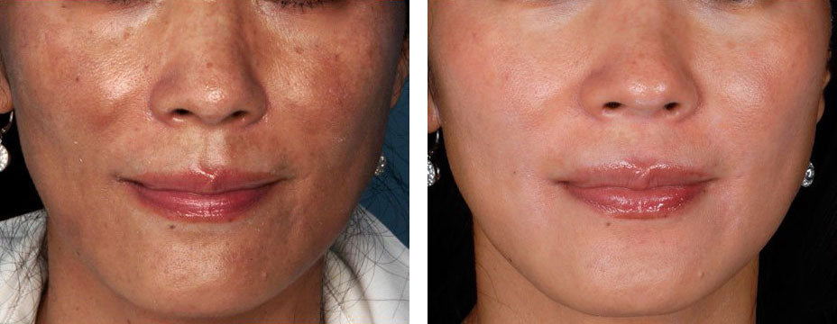 ZO-Non-Hydroquinone-Hyperpigmentation-System