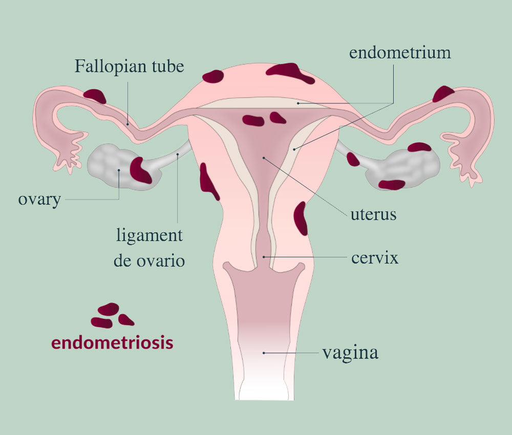 PLANT-BASED TREATMENT OPTIONS FOR ENDOMETRIOSIS