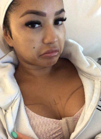 kady-jo after breast implant revision