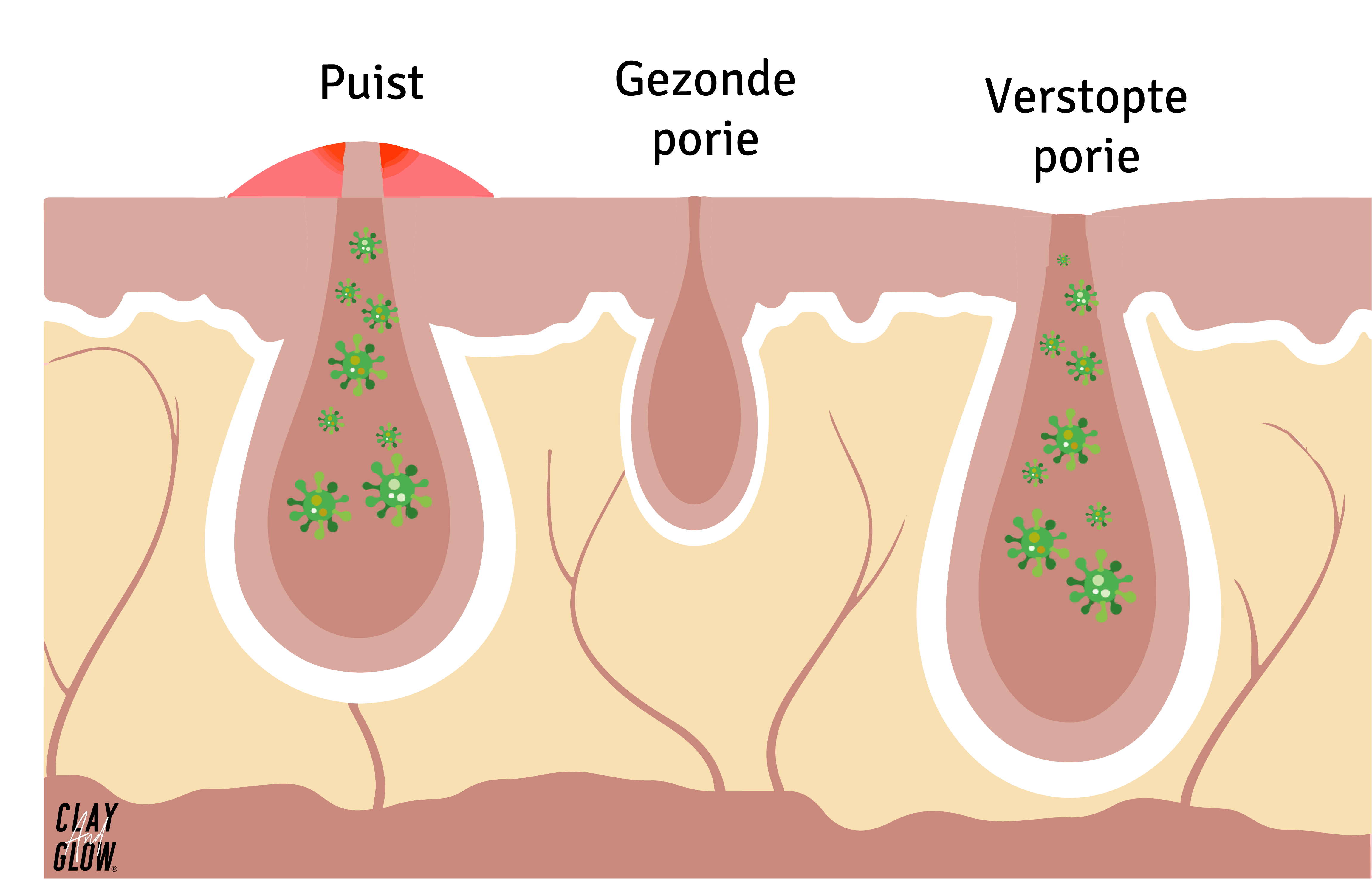 uitleg van de verstopte poriën