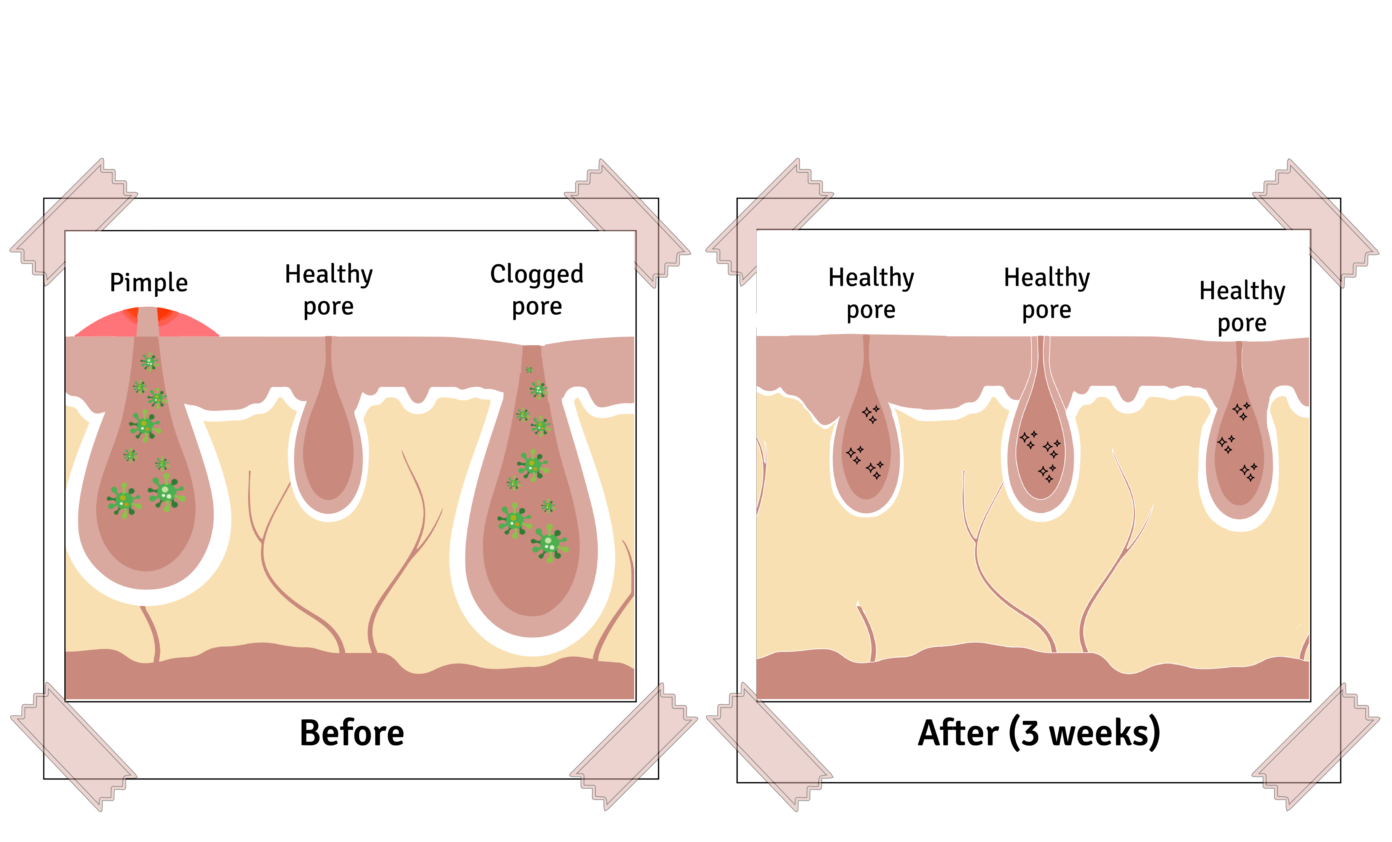 proven results before and after smaller pores