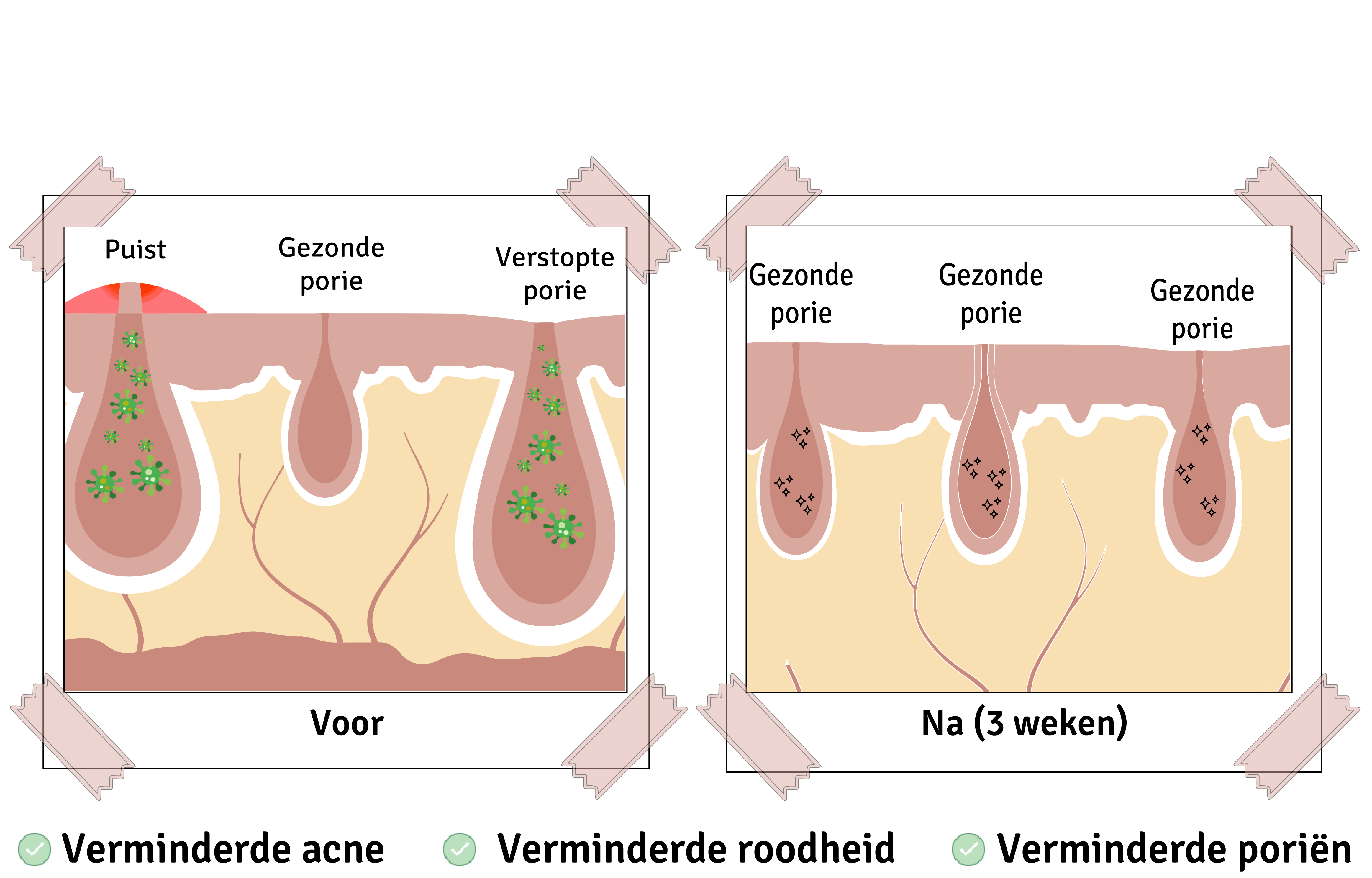 voor en na 3 weken resultaten roze klei masker