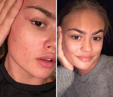It's a Miracle: After just 2 weeks taking StarPowa, Ella's skin was completely clear of breakouts.