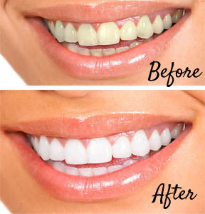 Before and After. Brighten your Smile for White Teeth