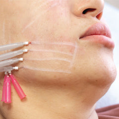 Esthetician Performing a Mini Facelift with PDO Threads