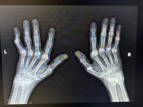 Arthritis Hands