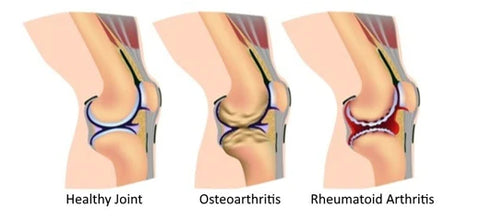 rheumatoid arthritis vs. osteoarthritis in knee