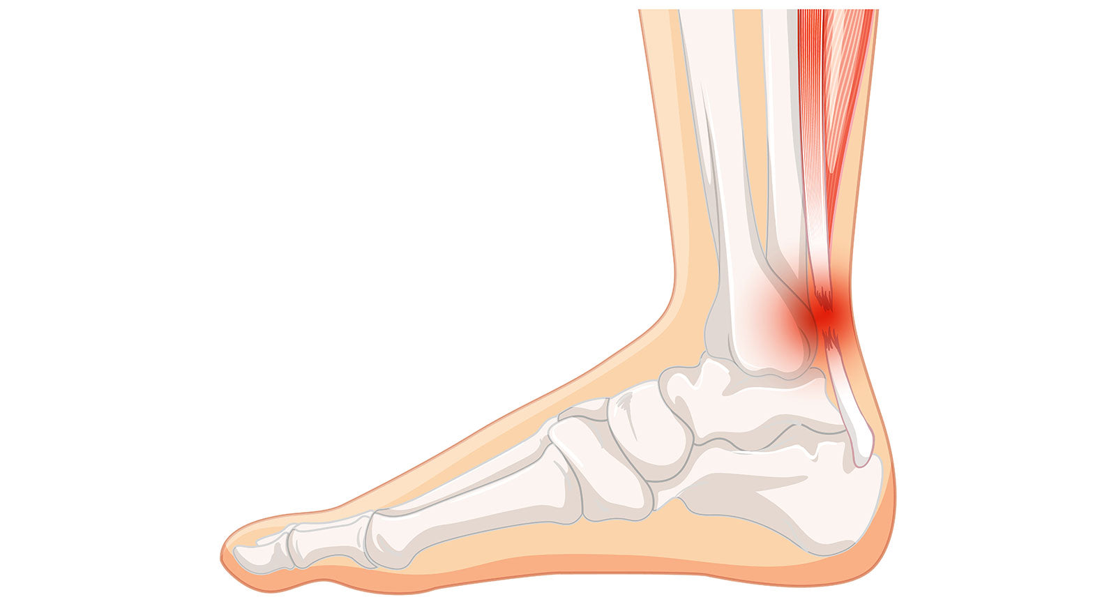 Chronic Lateral Ankle Pain: Causes and Treatment Option