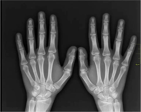 Healthy hands x-ray