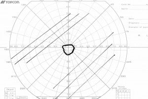 Goldmann visual fields - Glaucoma & RP Simulators with 20° visual field