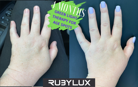 Before & After Photos Green Light Therapy Left Hand