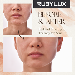 RubyLux Red and Blue Light Therapy for Acne Pimples Breakouts Zits Before and After