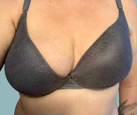 Symmetrista: Asymmetrical bras for uneven breasts