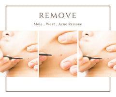RF Mole & Acne Remove 射頻氣化脱疣療程