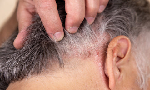 ringworm in humans scalp