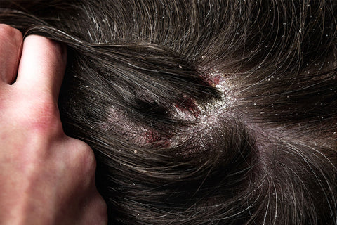 Does an Oily Scalp Cause Hair Loss  TouchUps Salon