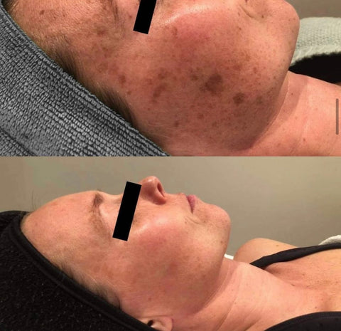 results using the m22 ipl machine at facetime skin clinic for ipl skin rejuvenation