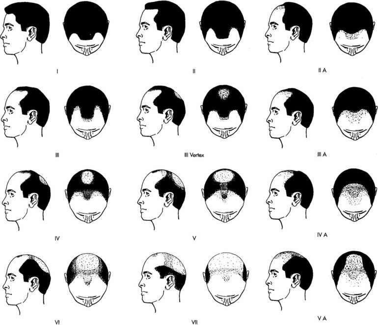 Hair Loss Chart Norwood