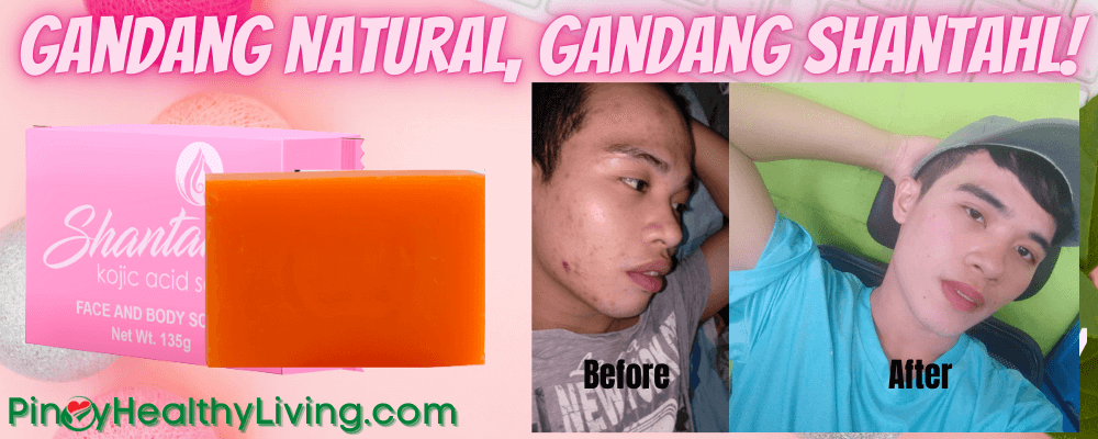 Shantahl Kojic Soap for Acne | Japan Formula – Pinoy Healthy Living