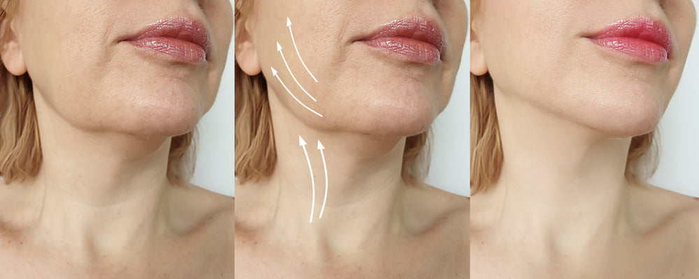 sculptra results