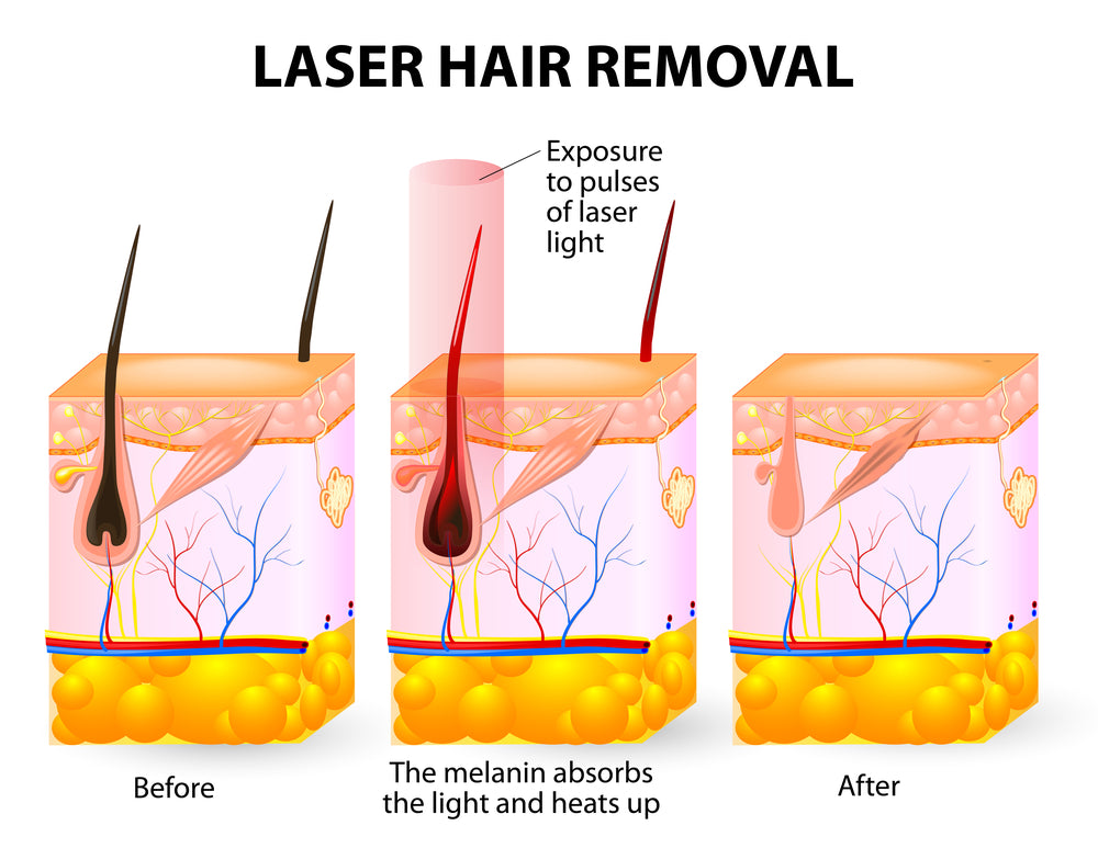 laser hair removal process explained 