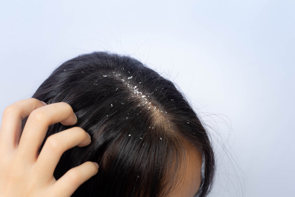 Ringworm of The Scalp Tinea Capitis  Causes Symptoms And Remedies