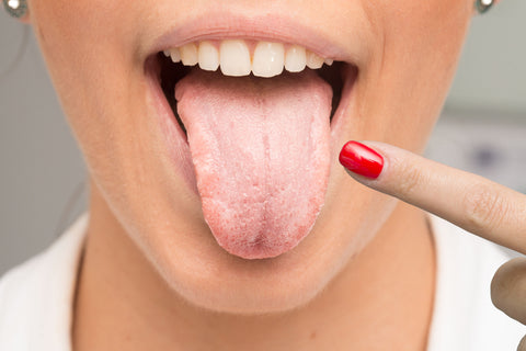 Oral thrush on woman's tongue