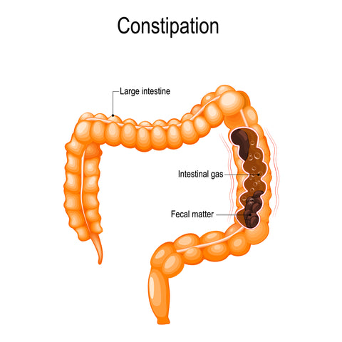 Image of constipated colon