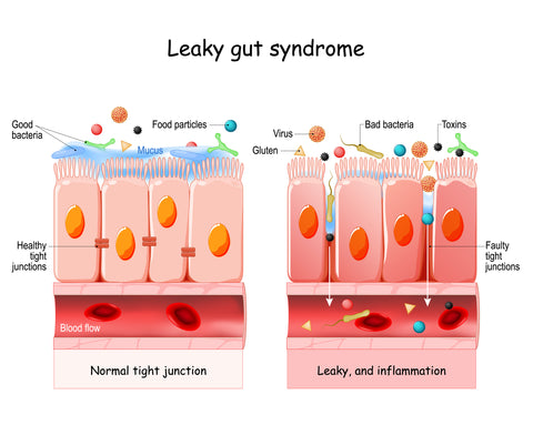 Leaky gut syndrome graphic