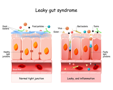 Leaky Gut Syndrome Visual Graphic