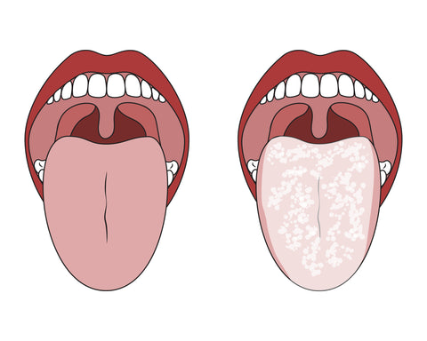 Oral Thrush vs healthy tongue