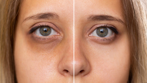 Pictures of a woman with dark under eye circle compared to a normal eye